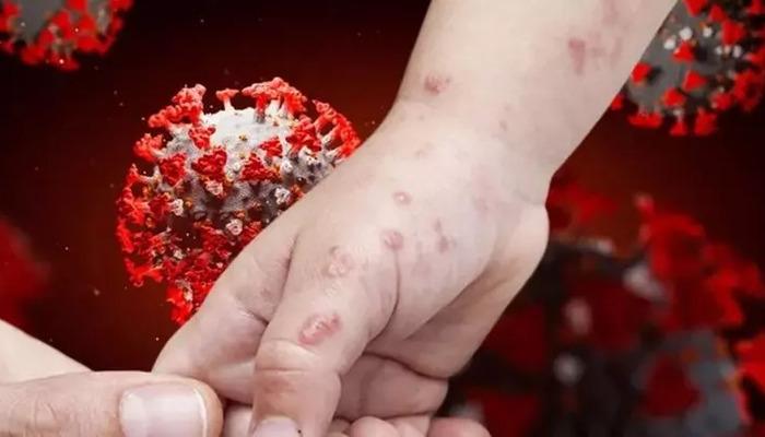 Maymun çiçeği virüsü vakaları haberleri sonrası Türkiye’de de harekete geçildi! “Gerekli tüm önlemler alındı”