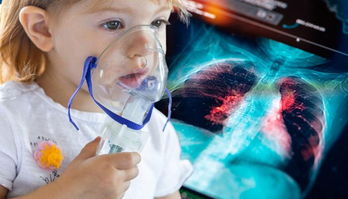 Öksürüğünden kurtulamıyor musun? Yeni Tehlike: Yürüme Pnömonisi Yükselişte! Soğukla ​​karıştırılmamalı