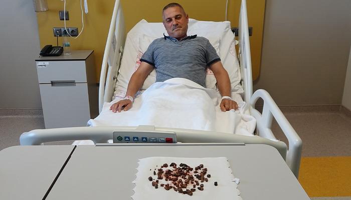 Doktorları şaşkına çeviren vaka: Adamın böbreğinden 100’e yakın taş çıktı: “Sağ böbreğin tamamı taşla doluydu”